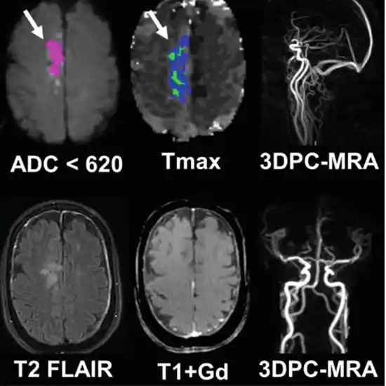 MRI Screening of Brain + DWI + MRA + Neck Test